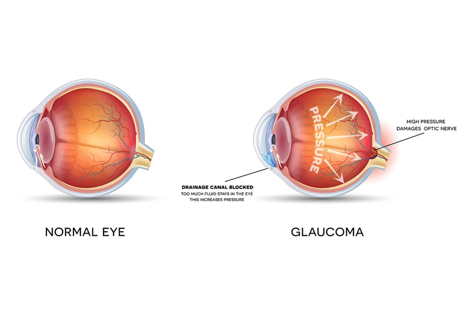 Glaucoma evaluation and eye pressure management at Sarojana Eye Hospital, Hasthinapuram, Hyderabad