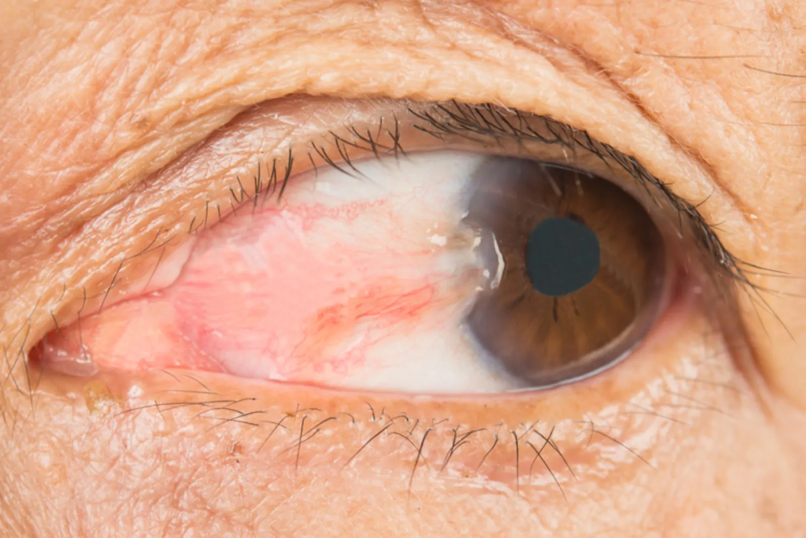 Pterygium surgery treatment at Sarojana Eye Hospital, Hasthinapuram, Hyderabad